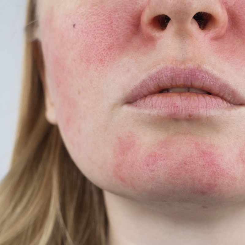 Redness Flushing And Rosacea Treatment Melbourne