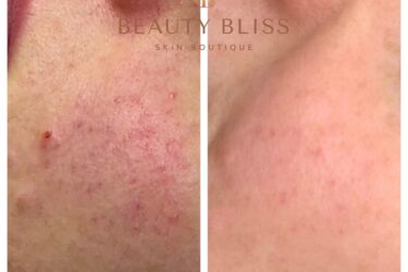 vascular laser at Beauty Bliss