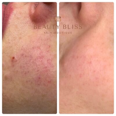 Vascular Laser at Beauty Bliss vascular laser at Beauty Bliss