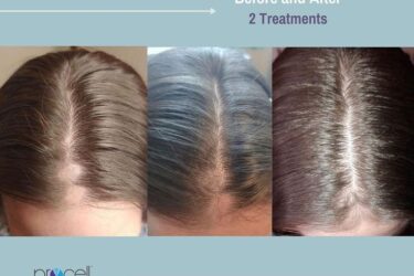 Procell Before And After E1675949241181