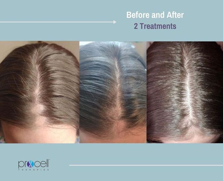 Procell Before And After E1675949241181