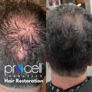 Procell Hair 1