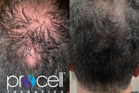 Procell Hair 1 Procell Hair 1
