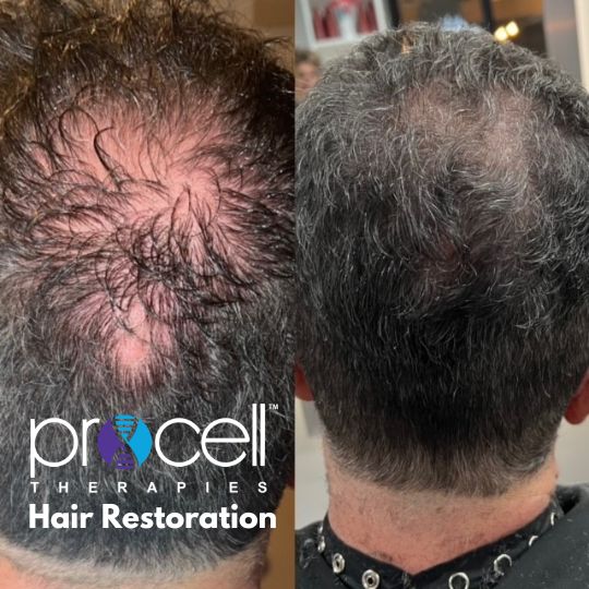 Procell Hair 1