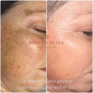 Beforeandafter
