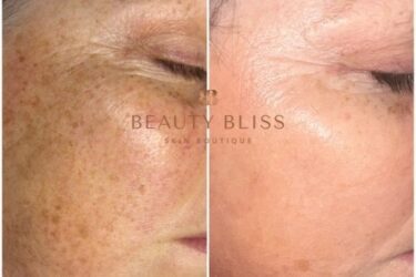 Beforeandafter