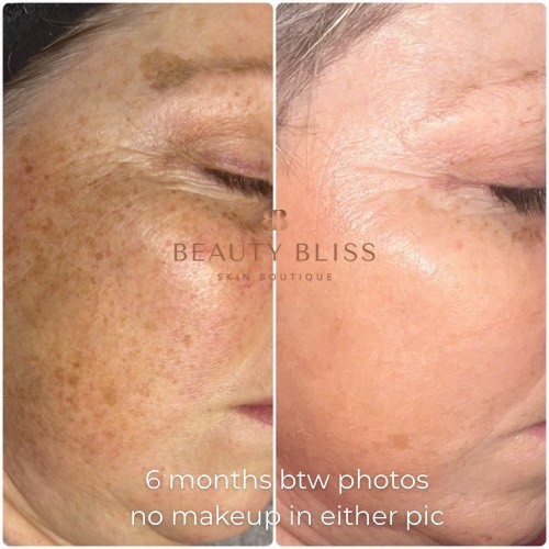 Beforeandafter