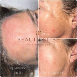 1 Treatment