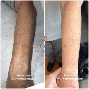 Before Ipl Photorejuvenation 1