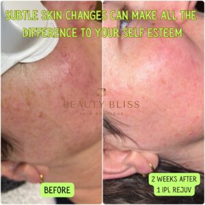 Before Ipl Photorejuvenation