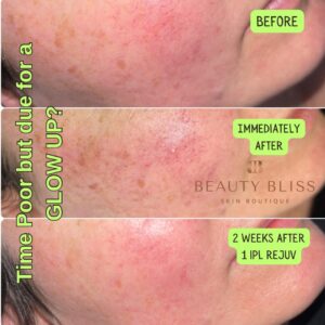 Before Ipl Photorejuvenation(1)