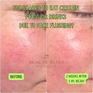 Before Ipl Photorejuvenation(2)