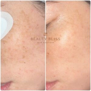 Beforeandafterpigmentation