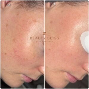 Beforeandafterfreckles
