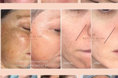 skin transformation